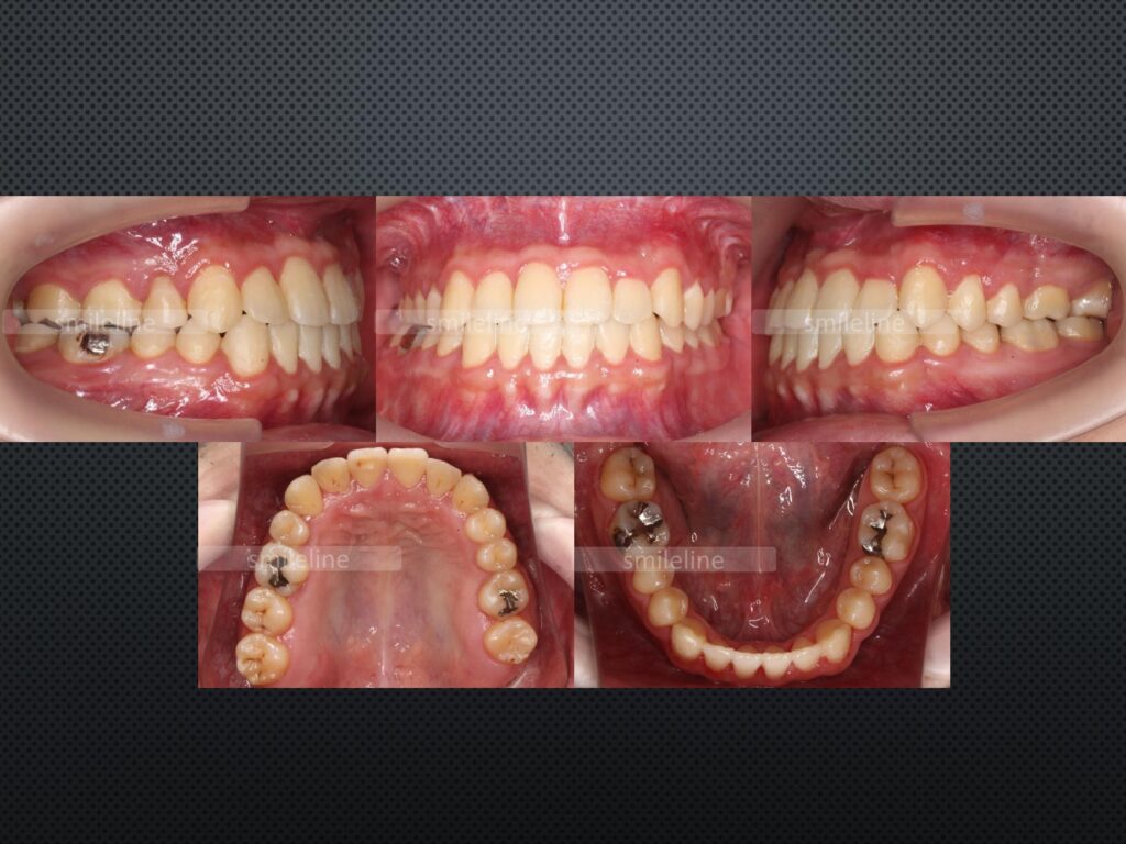 【2024/3/26】矯正歯科4_受け口・開咬(Aftre)｜池袋の歯医者・歯科「Lily Smile Dental Clinic」