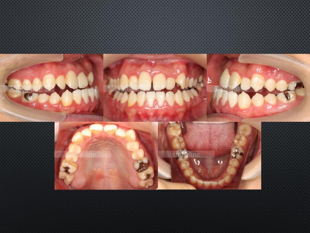 【2024/3/26】矯正歯科4_受け口・開咬(Before)｜池袋の歯医者・歯科「Lily Smile Dental Clinic」