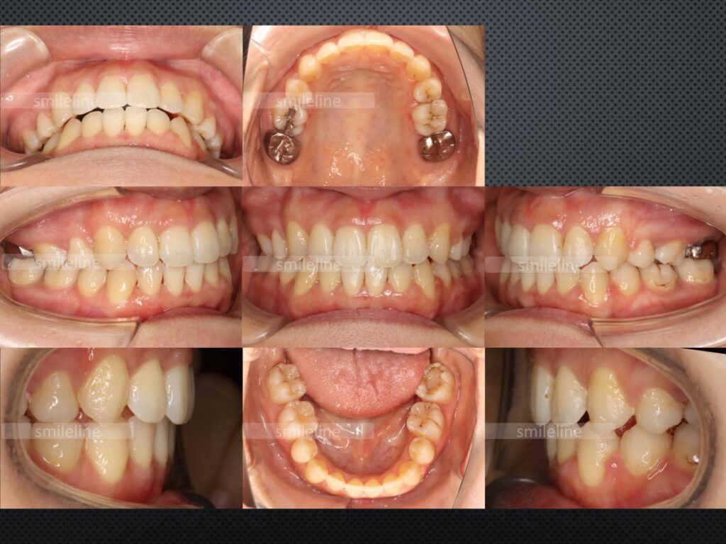 【2024/3/26】矯正歯科3_八重歯(Aftre)｜池袋の歯医者・歯科「Lily Smile Dental Clinic」