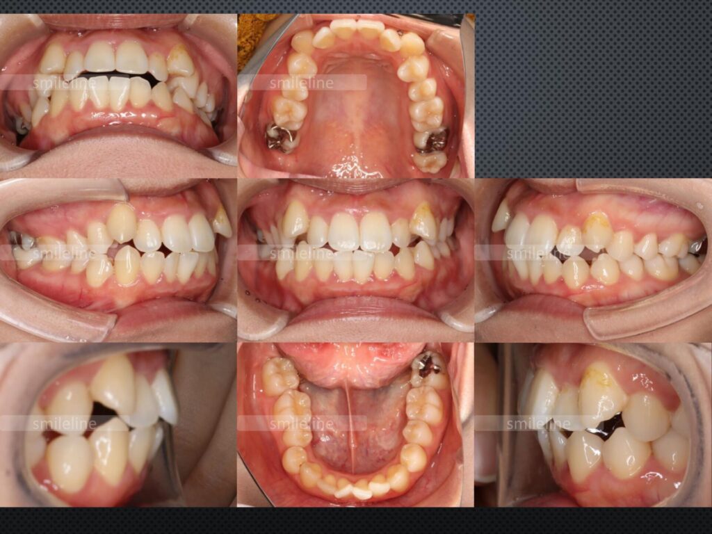 【2024/3/26】矯正歯科3_八重歯(Before)｜池袋の歯医者・歯科「Lily Smile Dental Clinic」