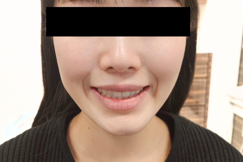粘膜切除術｜池袋の歯医者・歯科「Lily Smile Dental Clinic」