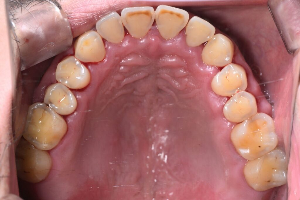 【2025/7/3】エアフロー(Aftre)｜池袋の歯医者・歯科「Lily Smile Dental Clinic」