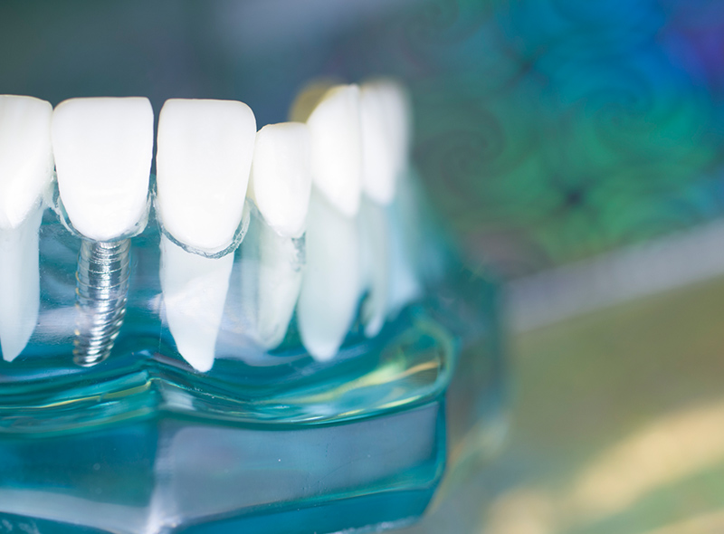 インプラントや外科処置を正確にしてほしい|池袋の歯医者・歯科「Lily Smile Dental Clinic」
