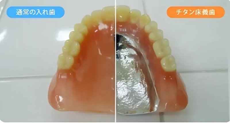 金属床義歯(チタン床)|池袋の歯医者・歯科「Lily Smile Dental Clinic」