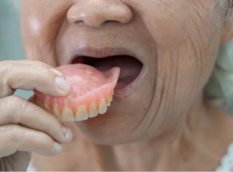 装着|池袋の歯医者・歯科「Lily Smile Dental Clinic」