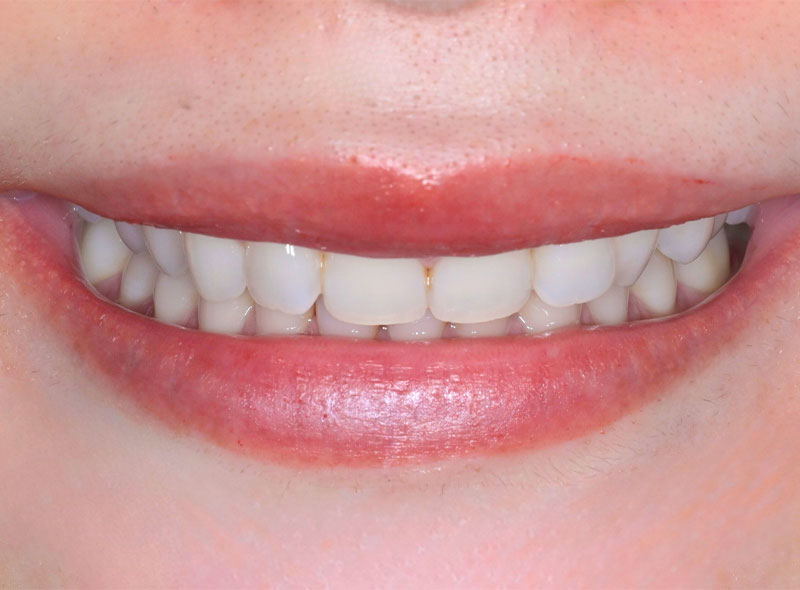 ガミースマイル治療について｜池袋の歯医者・歯科「Lily Smile Dental Clinic」