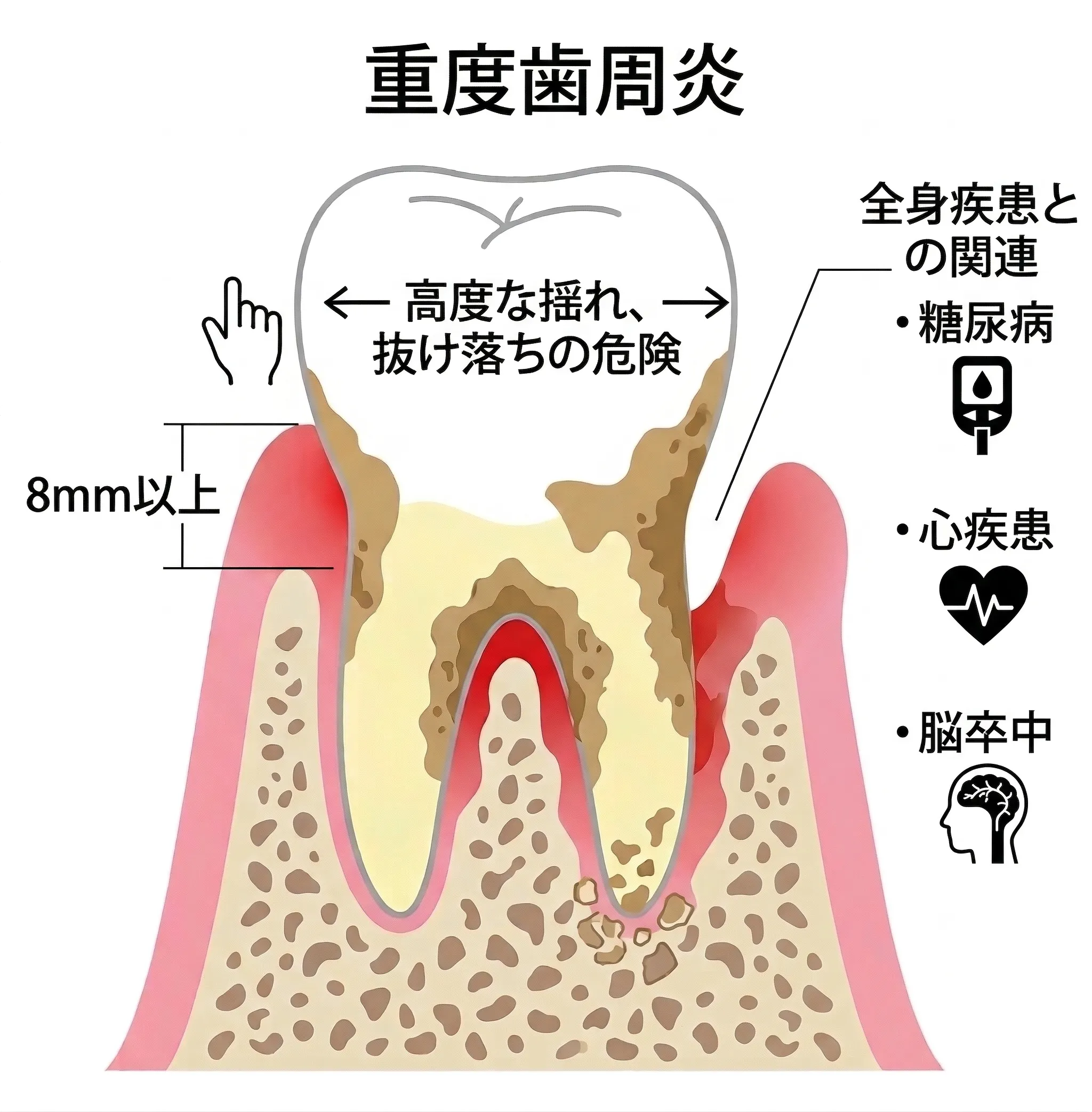 重度歯周炎