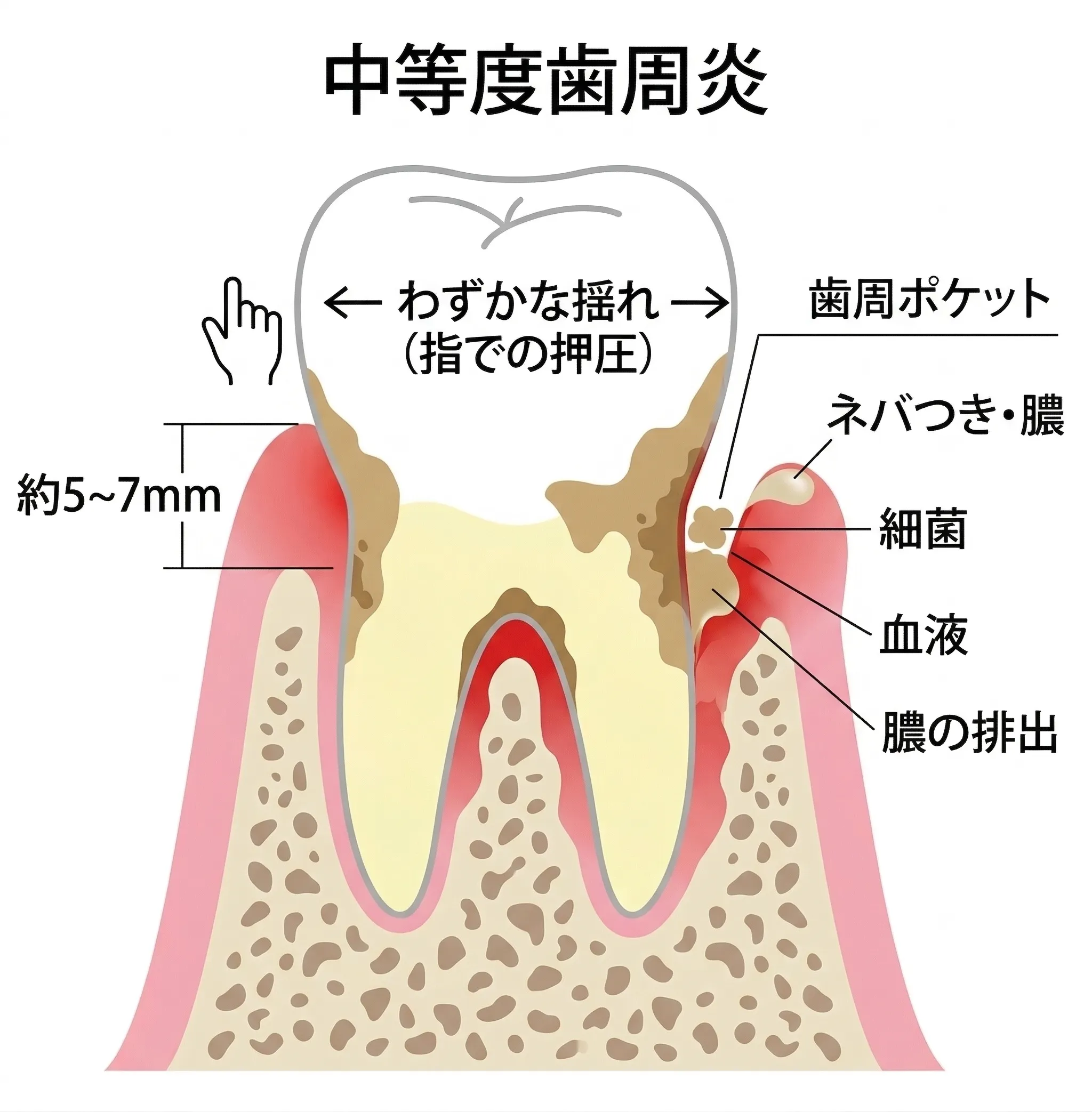 中等度歯周炎