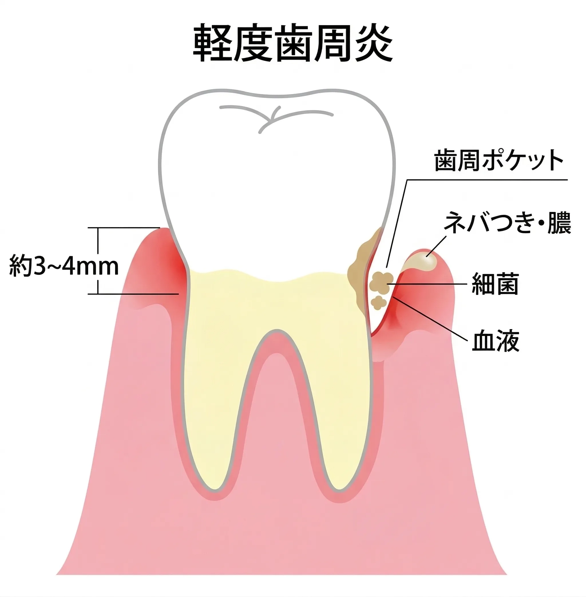 軽度歯周炎