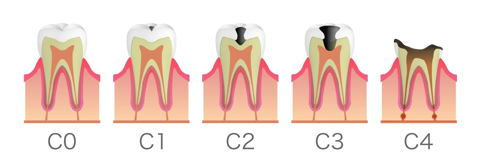 根管治療について|池袋の歯医者・歯科「Lily Smile Dental Clinic」