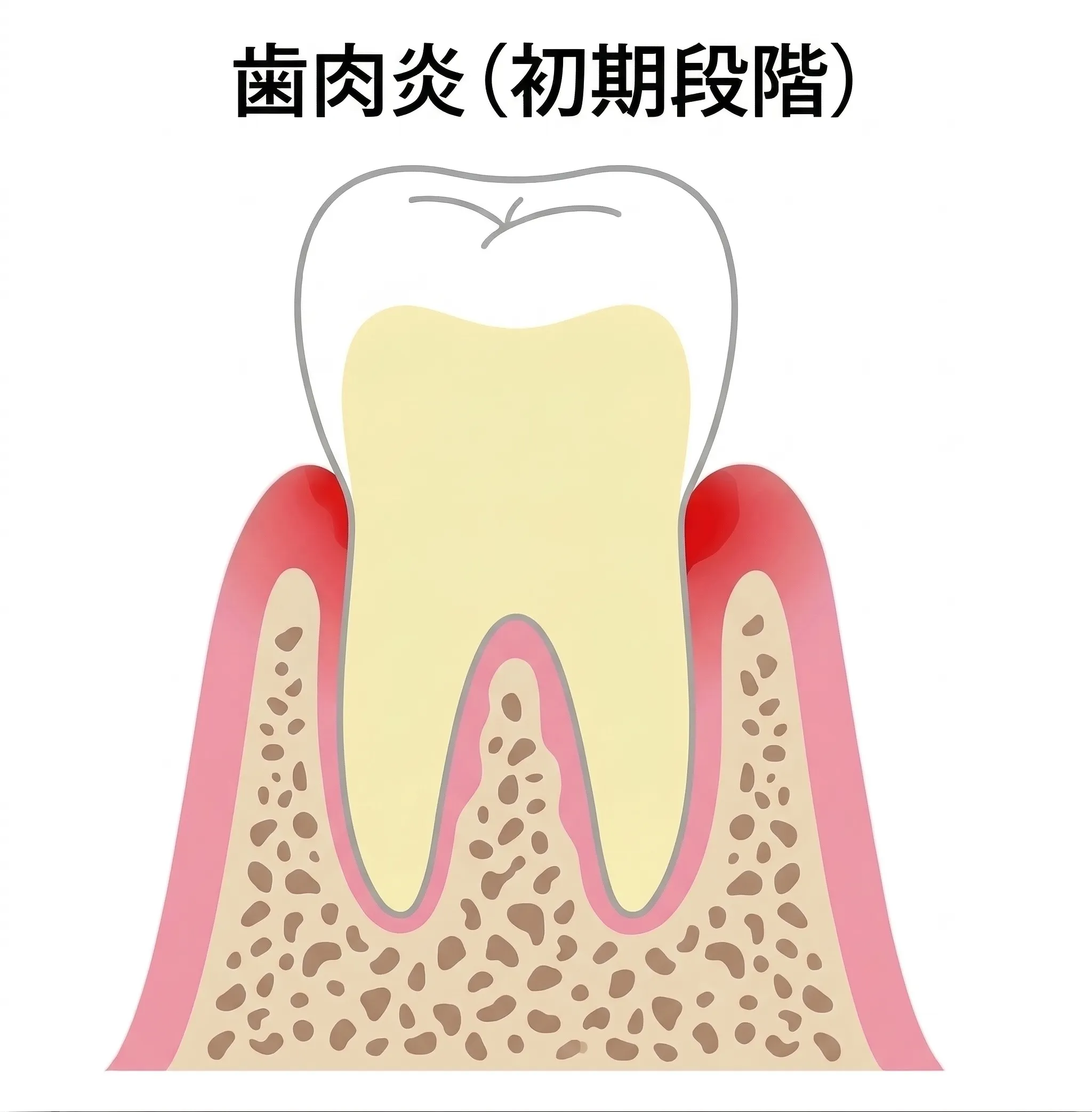 歯肉炎(初期段階)