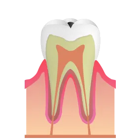 象牙質の虫歯|池袋の歯医者・歯科「Lily Smile Dental Clinic」