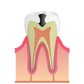 重度の虫歯|池袋の歯医者・歯科「Lily Smile Dental Clinic」