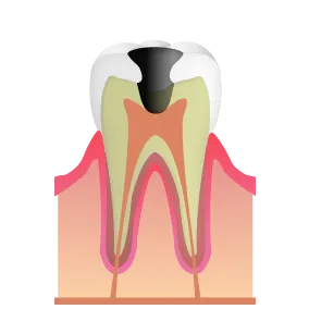 初期虫歯|池袋の歯医者・歯科「Lily Smile Dental Clinic」