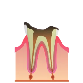 初期虫歯|池袋の歯医者・歯科「Lily Smile Dental Clinic」