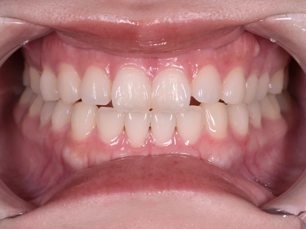 after|池袋の歯医者・歯科「Lily Smile Dental Clinic」