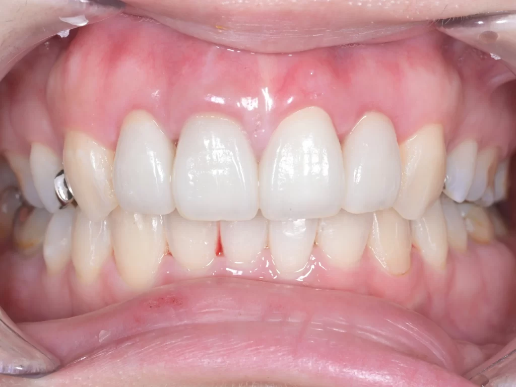 after|池袋の歯医者・歯科「Lily Smile Dental Clinic」