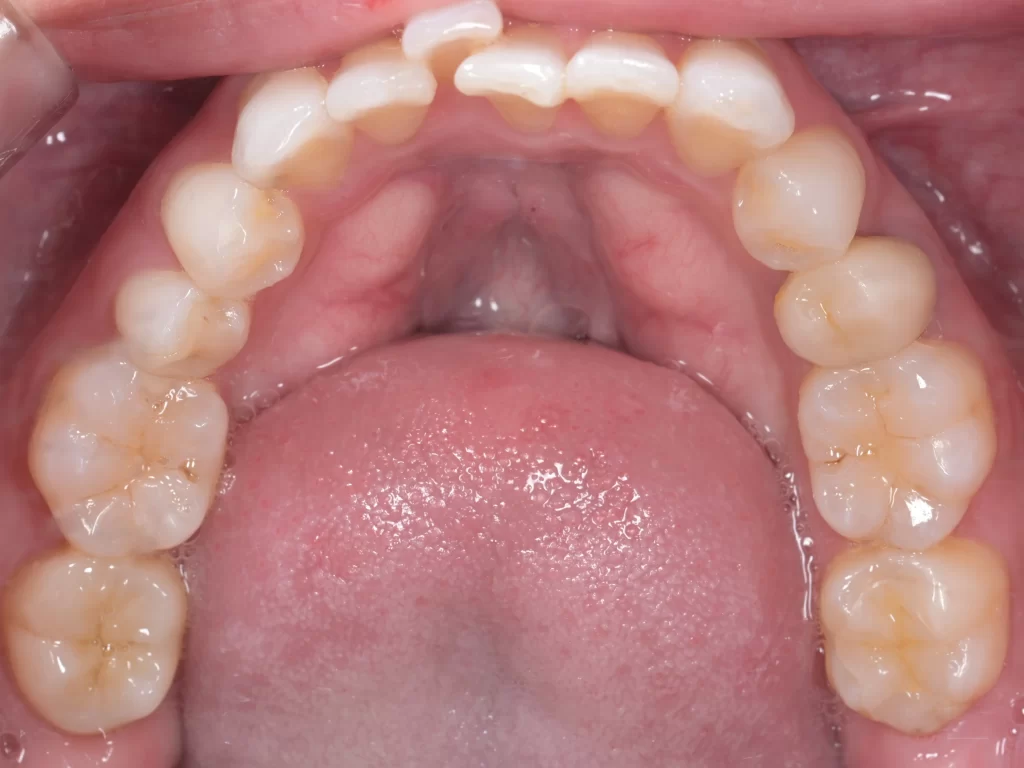 after|池袋の歯医者・歯科「Lily Smile Dental Clinic」