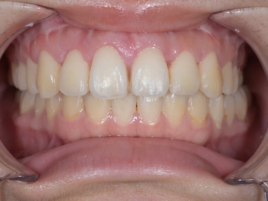after|池袋の歯医者・歯科「Lily Smile Dental Clinic」