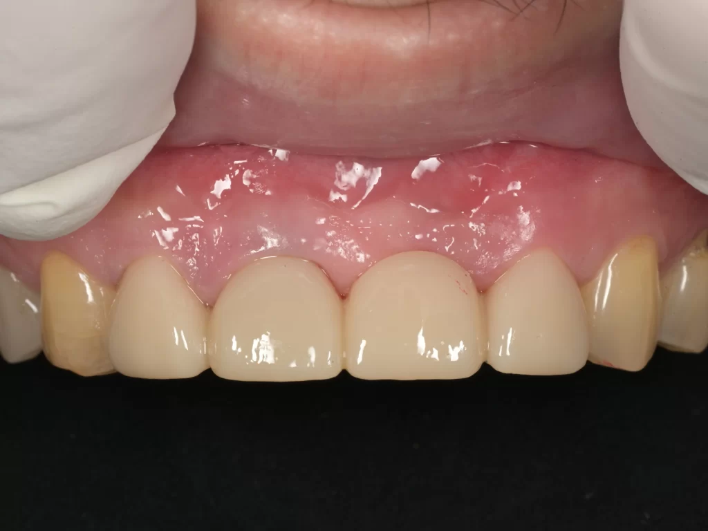 after|池袋の歯医者・歯科「Lily Smile Dental Clinic」