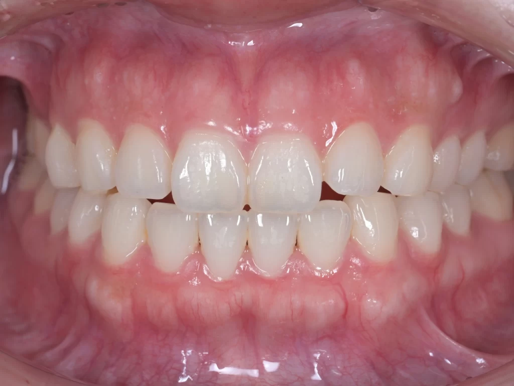 before|池袋の歯医者・歯科「Lily Smile Dental Clinic」