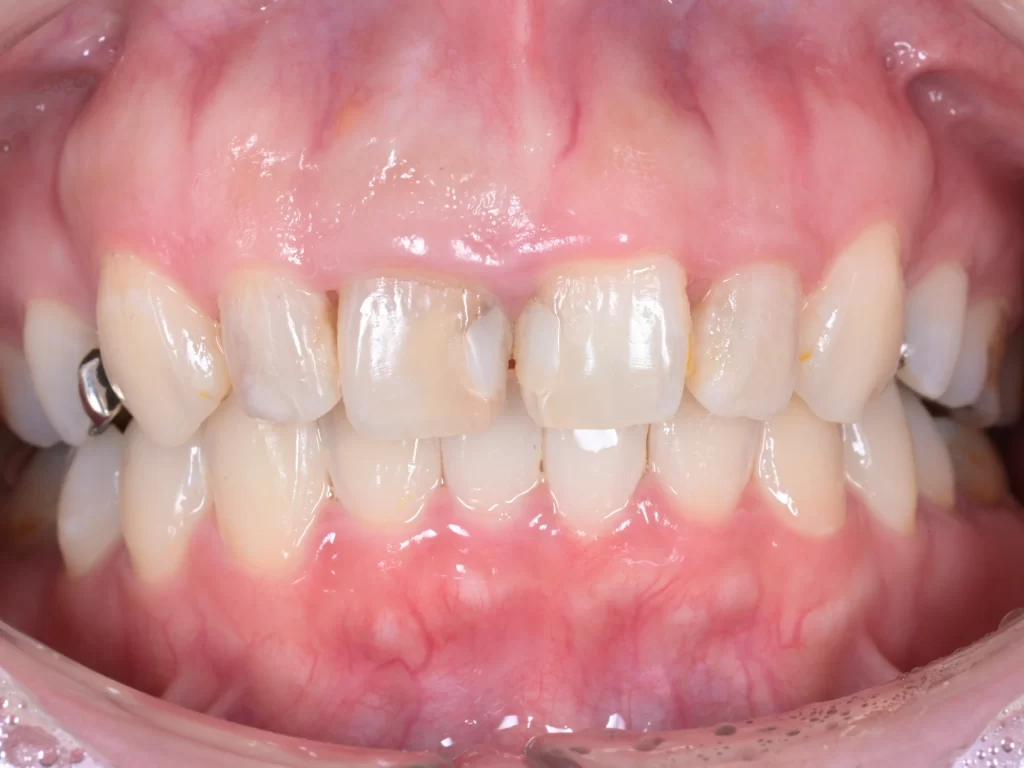 before|池袋の歯医者・歯科「Lily Smile Dental Clinic」