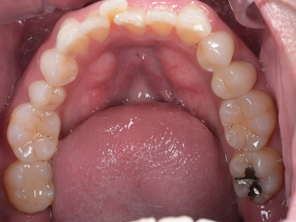 before|池袋の歯医者・歯科「Lily Smile Dental Clinic」