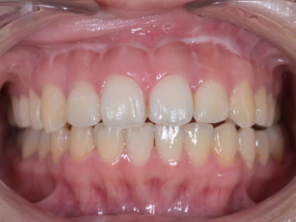 before|池袋の歯医者・歯科「Lily Smile Dental Clinic」