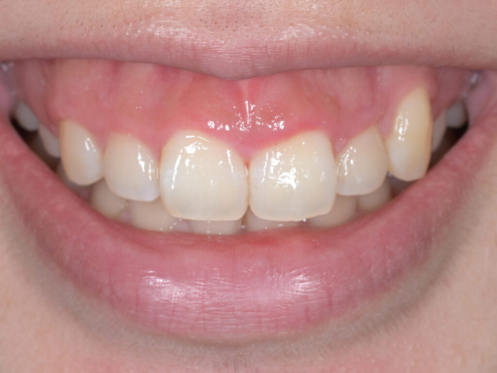 before(歯冠延長術)